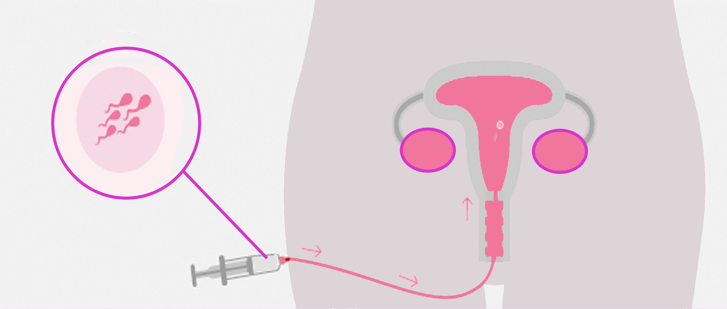 Inseminación intrauterina