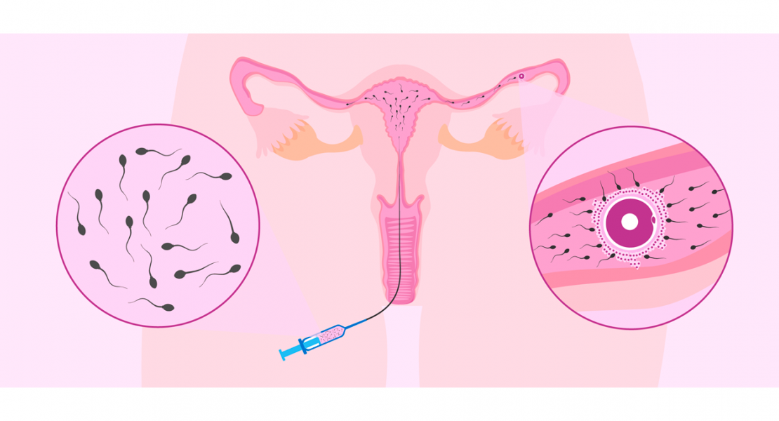 Inseminación Intrauterina Lima Perú